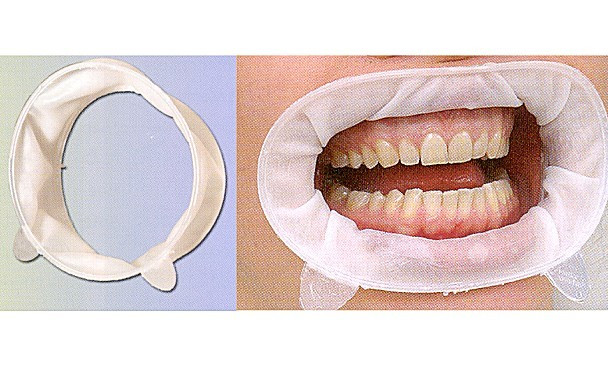 Apribocca con ali extra e intraorali, bianco - Negozio Ortho Depot per  ortodontisti, dentisti e cliniche