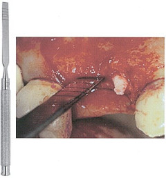 H.F. OSTEOTOMO OSS 6518S