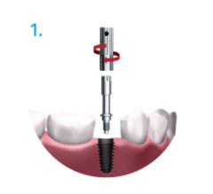 OSSEO 100 NSK MULTIPEG TYPE 59 55067