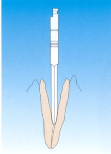 PERNI DENTATUS REAMERS S1 X3